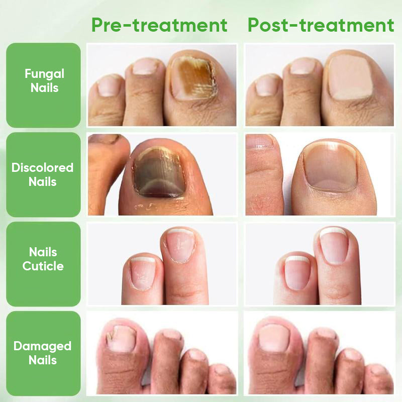 Ginger Nail Treatment