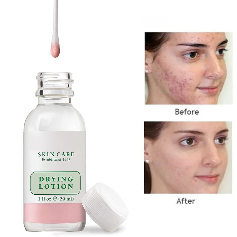 Drying Lotion Targeted Acne Spot Treatment for Blemish Relief